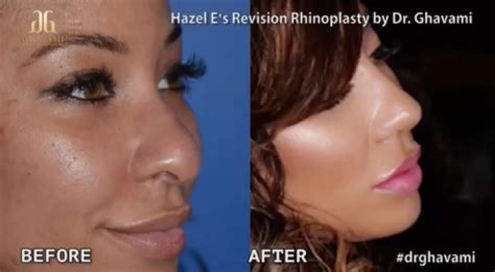 Hazel E Before The Surgery
