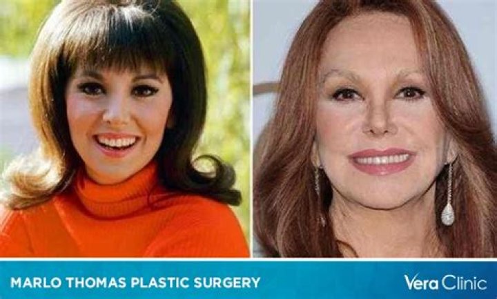 Marlo Thomas's Plastic Surgery Journey